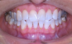 Pacient S.K.- před zrychlenou ortodontickou léčbou