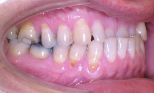 INVISALIGN, zrychlená ortodontická léčba - před