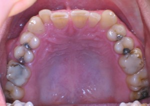INVISALIGN, zrychlená ortodontická léčba - před