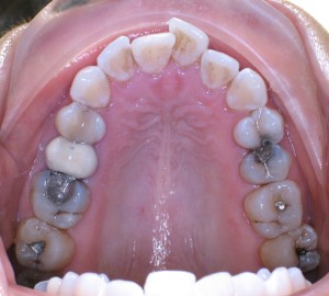Pacient S.K.- před zrychlenou ortodontickou léčbou