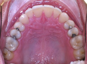 INVISALIGN, zrychlená ortodontická léčba - po estetické rekonstrukci