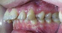 Pacientka K.K. před léčbou rovnání zubů