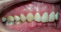 Pacient L.M. před rovnáním zubů