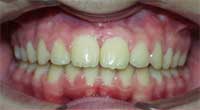Pacient M.K. po rovnání zubů