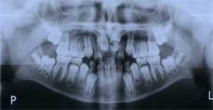 Pacient M.K. před rovnáním zubů