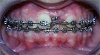 Pacient M.K. v průběhu rovnání zubů