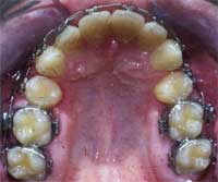 Pacient Š.P. v průběhu rovnání zub